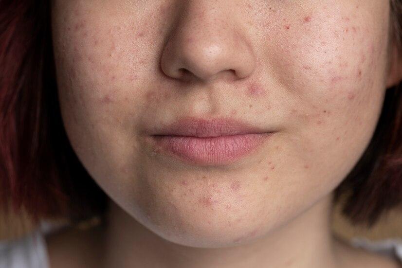 ใบหน้าที่มีรูขุมขนกว้างและรอยสิว เตรียมรับการรักษาด้วยเลเซอร์